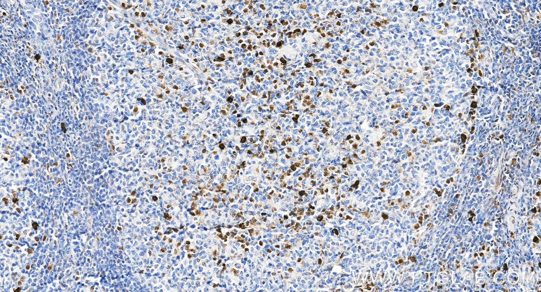 Immunohistochemistry (IHC) staining of human tonsillitis tissue using IRF4 Recombinant monoclonal antibody (87342-1-RR)