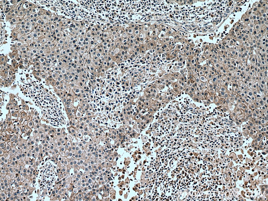 Immunohistochemistry (IHC) staining of human breast cancer tissue using IRF5 Polyclonal antibody (10547-1-AP)
