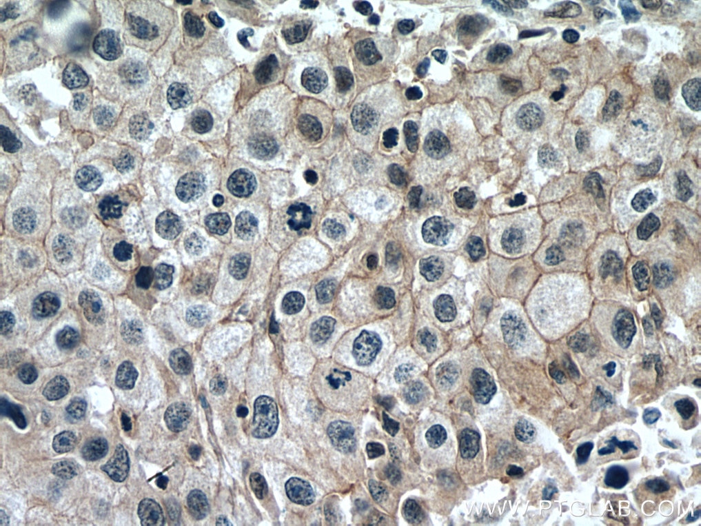 Immunohistochemistry (IHC) staining of human breast cancer tissue using IRF5 Polyclonal antibody (10547-1-AP)