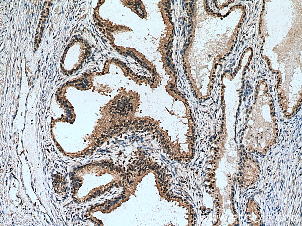 Immunohistochemistry (IHC) staining of human prostate cancer tissue using IRF5 Polyclonal antibody (10547-1-AP)