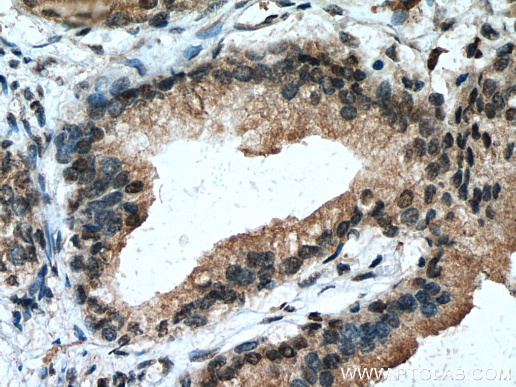 Immunohistochemistry (IHC) staining of human prostate cancer tissue using IRF5 Polyclonal antibody (10547-1-AP)