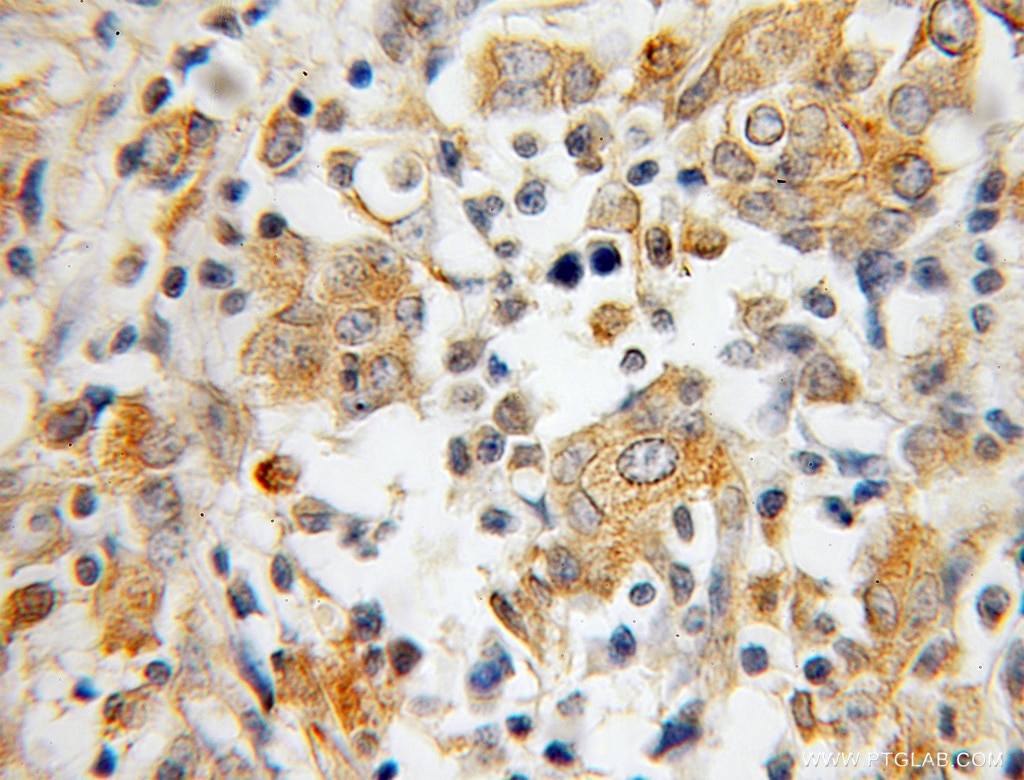 Immunohistochemistry (IHC) staining of human breast cancer tissue using IRF5 Polyclonal antibody (10547-1-AP)