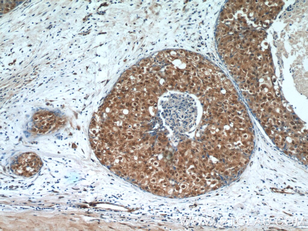 Immunohistochemistry (IHC) staining of human breast cancer tissue using IRF5 Monoclonal antibody (60088-1-Ig)