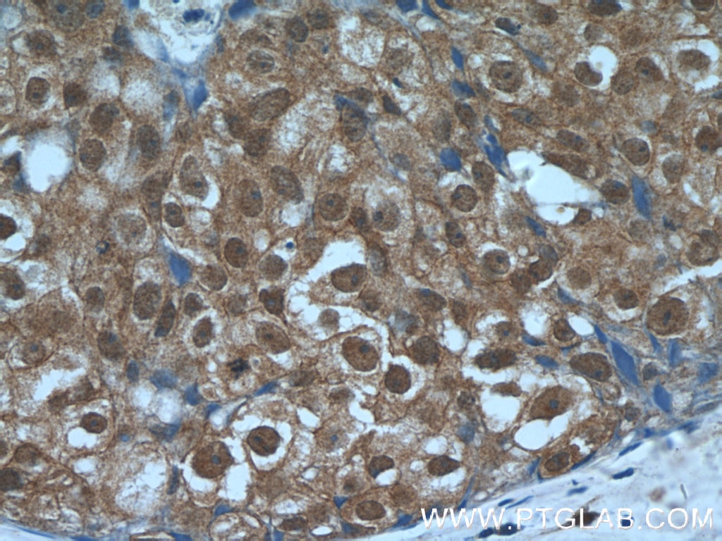 Immunohistochemistry (IHC) staining of human breast cancer tissue using IRF5 Monoclonal antibody (60088-1-Ig)