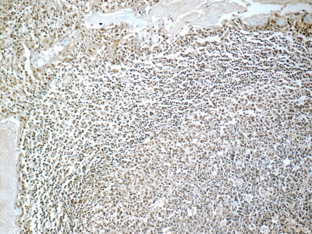 Immunohistochemistry (IHC) staining of human tonsillitis tissue using IRF5 Monoclonal antibody (60088-1-Ig)