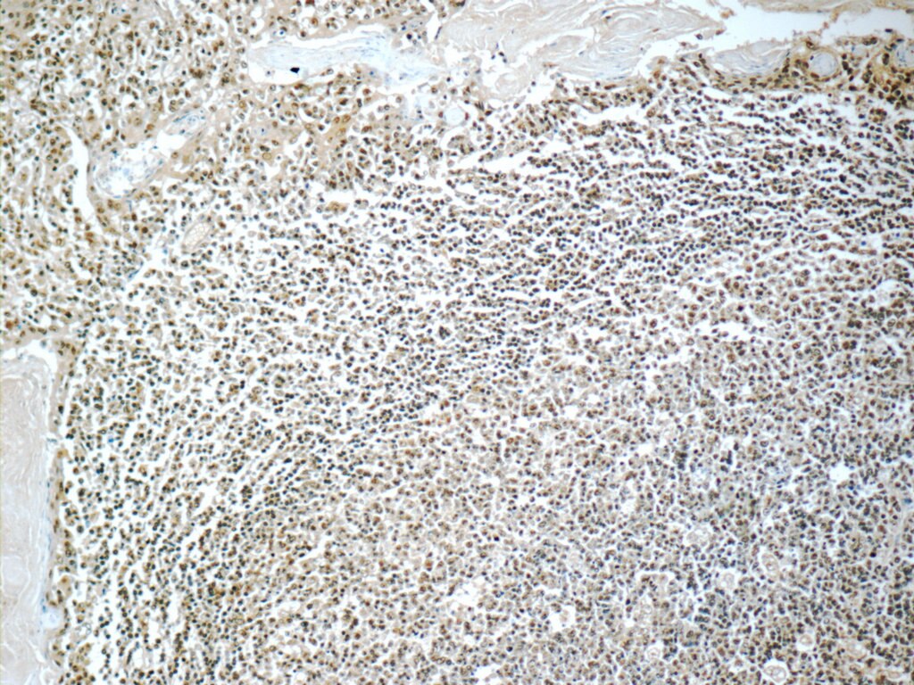 Immunohistochemistry (IHC) staining of human tonsillitis tissue using IRF5 Monoclonal antibody (60088-1-Ig)