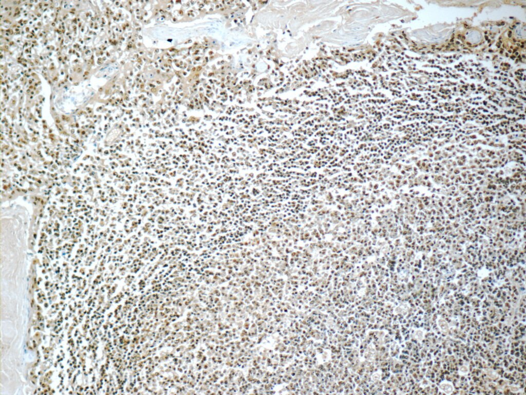 IHC staining of human tonsillitis using 60088-1-Ig