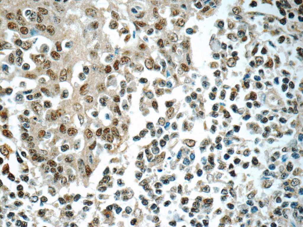 Immunohistochemistry (IHC) staining of human tonsillitis tissue using IRF5 Monoclonal antibody (60088-1-Ig)
