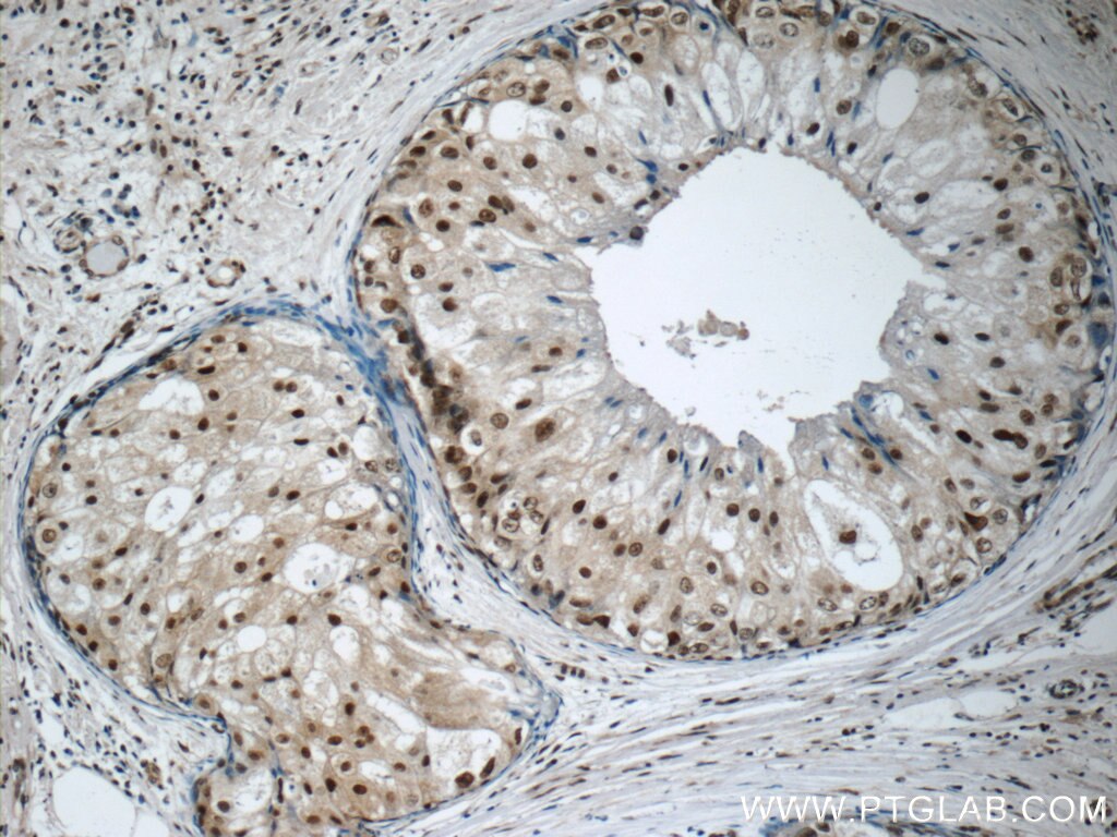 Immunohistochemistry (IHC) staining of human breast cancer tissue using IRF5 Monoclonal antibody (60088-1-Ig)