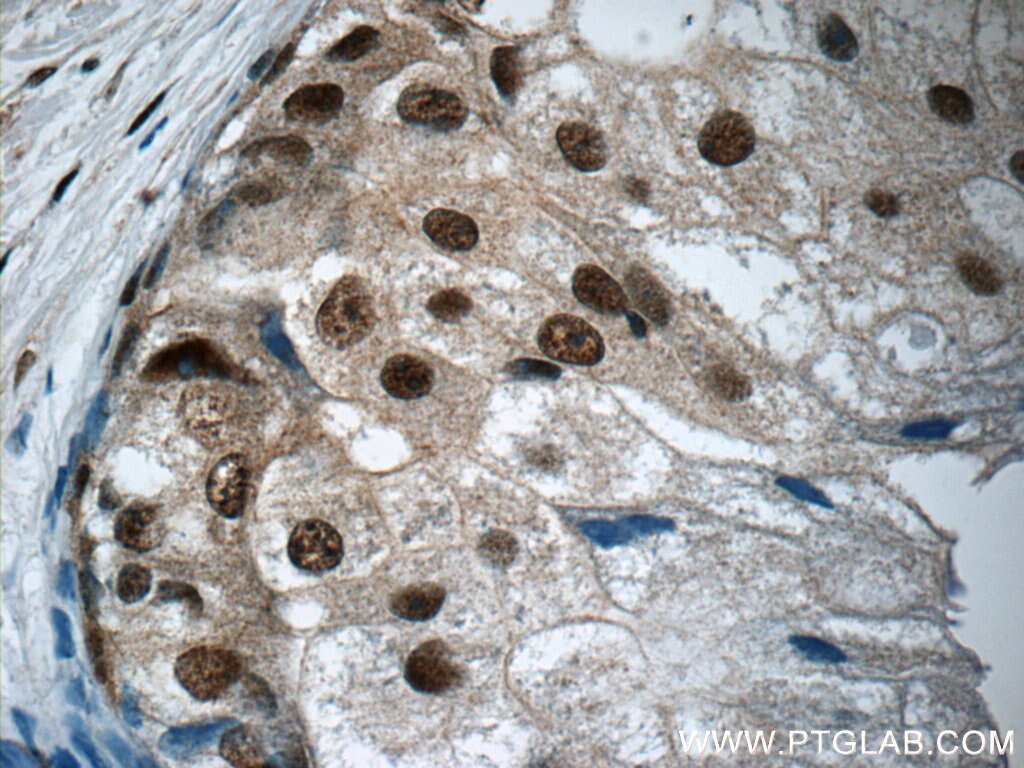 Immunohistochemistry (IHC) staining of human breast cancer tissue using IRF5 Monoclonal antibody (60088-1-Ig)