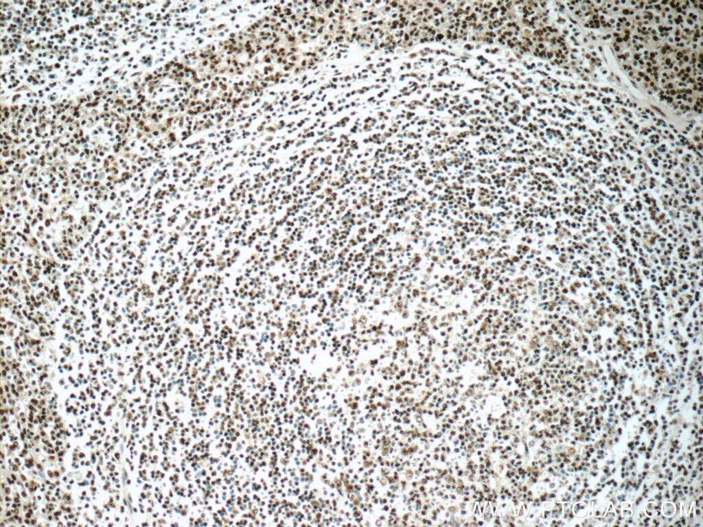 Immunohistochemistry (IHC) staining of human tonsillitis tissue using IRF5 Monoclonal antibody (60088-1-Ig)