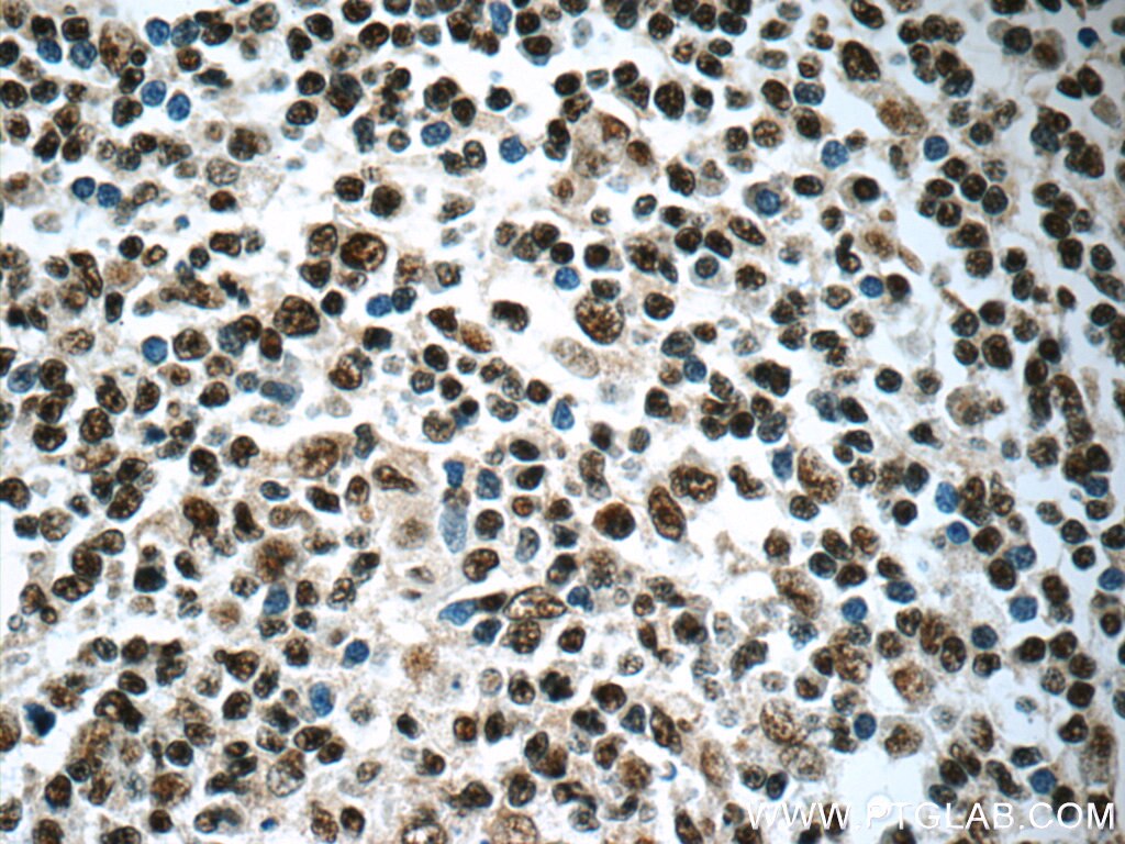 Immunohistochemistry (IHC) staining of human tonsillitis tissue using IRF5 Monoclonal antibody (60088-1-Ig)