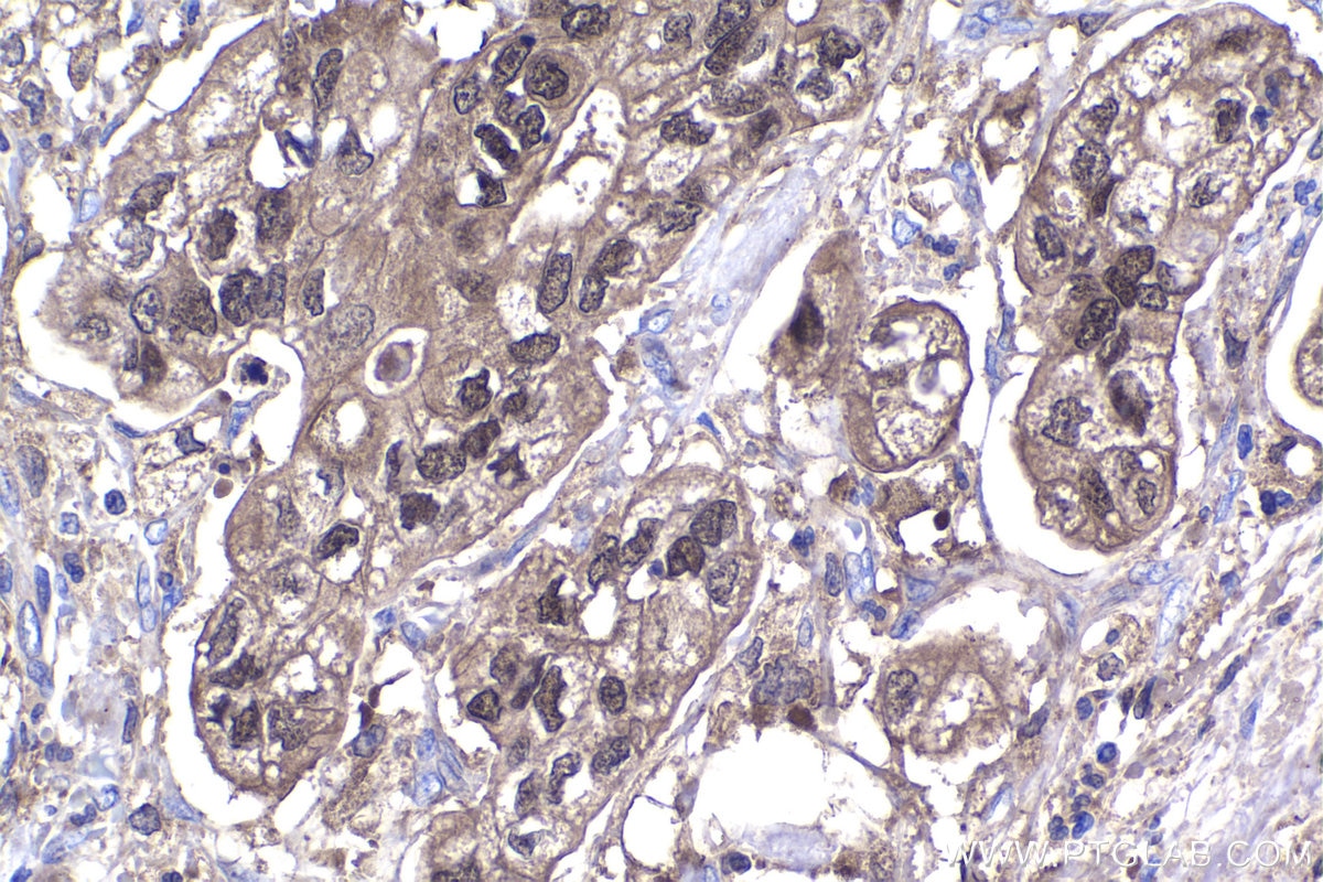 IHC staining of human stomach cancer using 12928-1-AP
