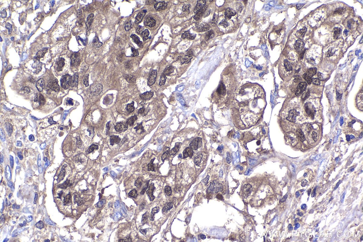 Immunohistochemistry (IHC) staining of human stomach cancer tissue using IRF6 Polyclonal antibody (12928-1-AP)