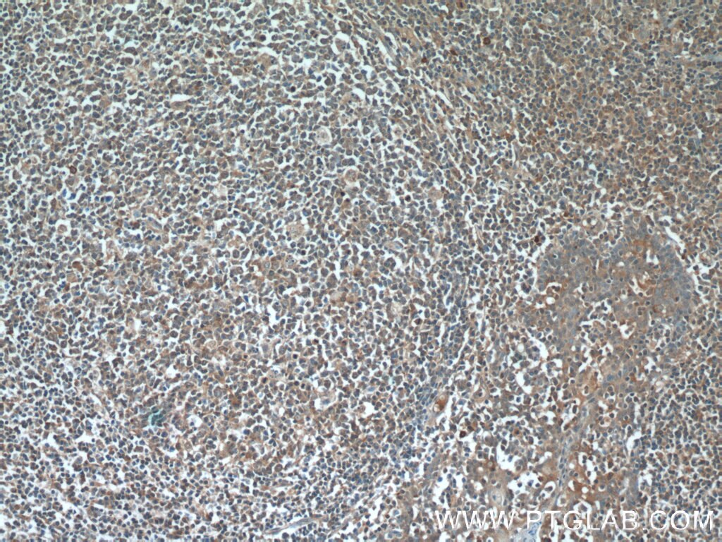 Immunohistochemistry (IHC) staining of human tonsillitis tissue using IRF7 Polyclonal antibody (22392-1-AP)