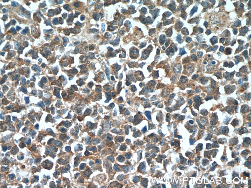 Immunohistochemistry (IHC) staining of human tonsillitis tissue using IRF7 Polyclonal antibody (22392-1-AP)
