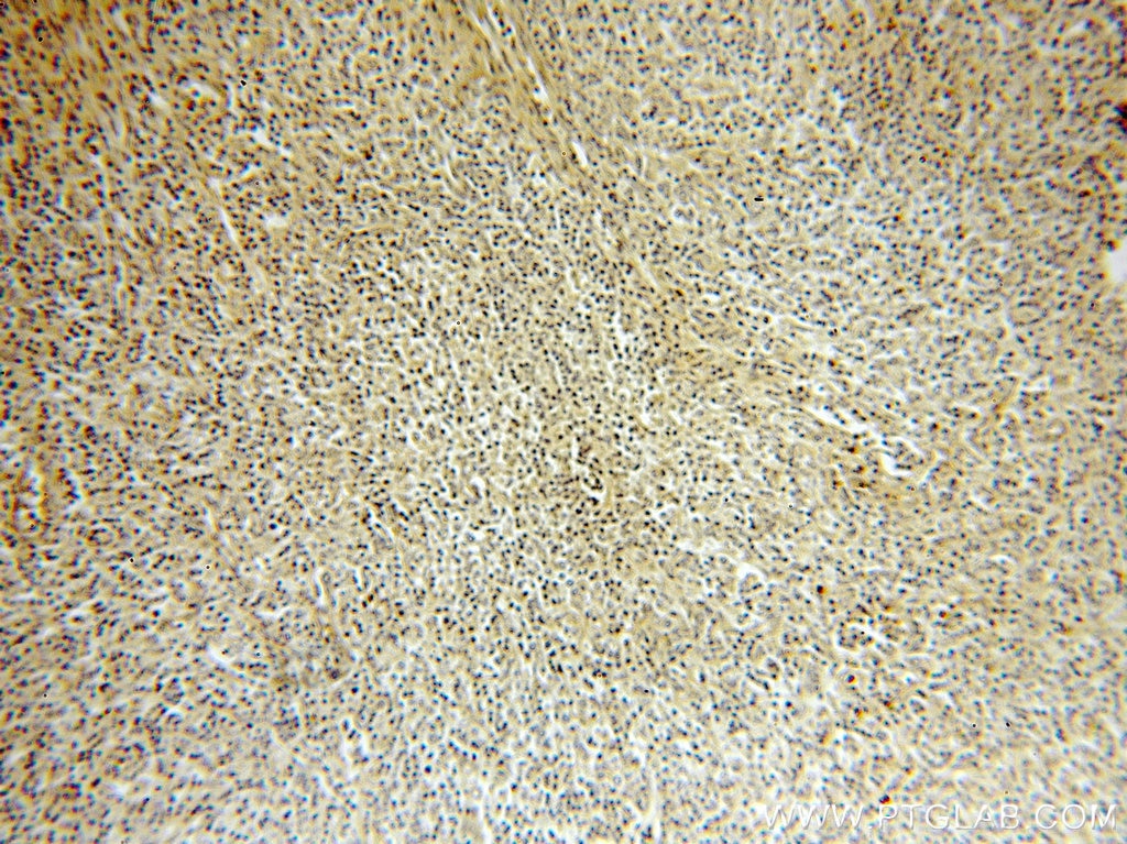 IHC staining of human lymphoma using 18977-1-AP