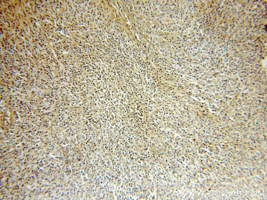 Immunohistochemistry (IHC) staining of human lymphoma tissue using IRF8 Polyclonal antibody (18977-1-AP)