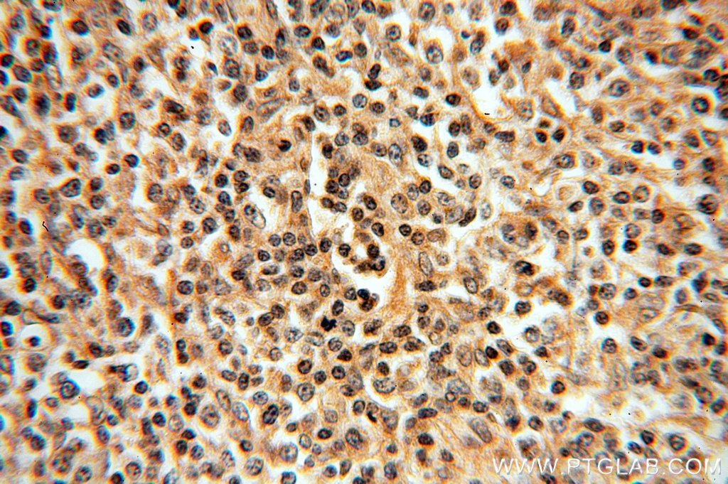 Immunohistochemistry (IHC) staining of human lymphoma tissue using IRF8 Polyclonal antibody (18977-1-AP)