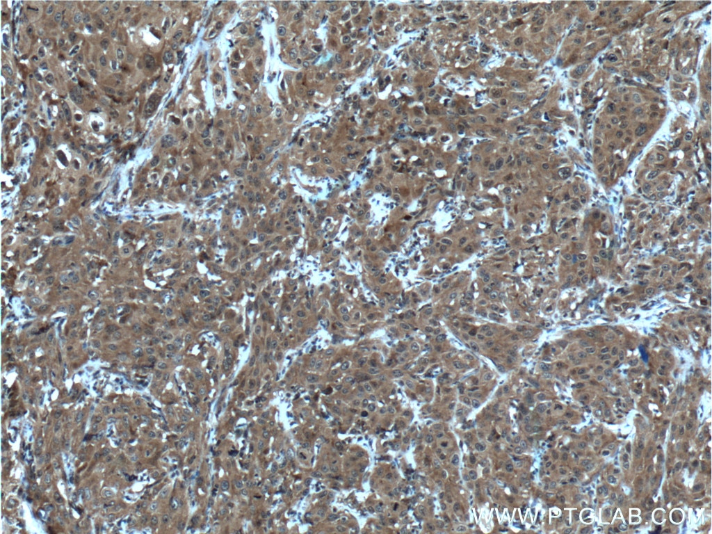 Immunohistochemistry (IHC) staining of human cervical cancer tissue using IRF9 Polyclonal antibody (14167-1-AP)
