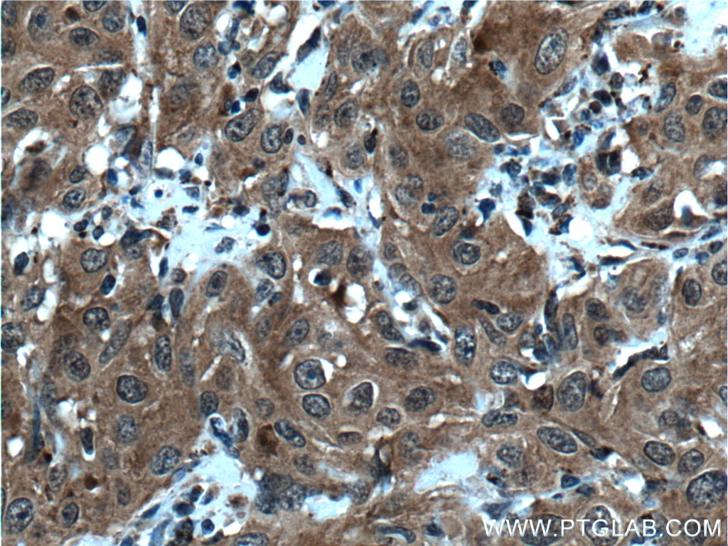 Immunohistochemistry (IHC) staining of human cervical cancer tissue using IRF9 Polyclonal antibody (14167-1-AP)