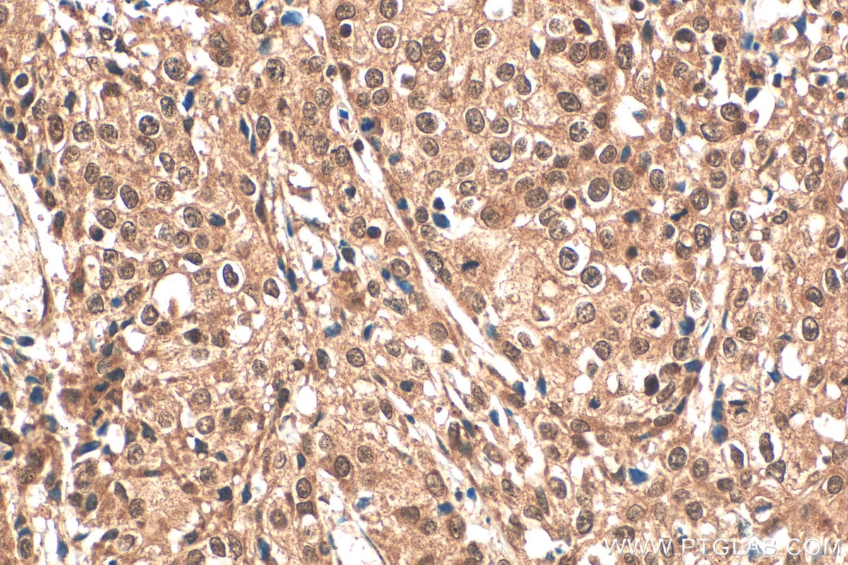 Immunohistochemistry (IHC) staining of human cervical cancer tissue using IRF9 Polyclonal antibody (14167-1-AP)