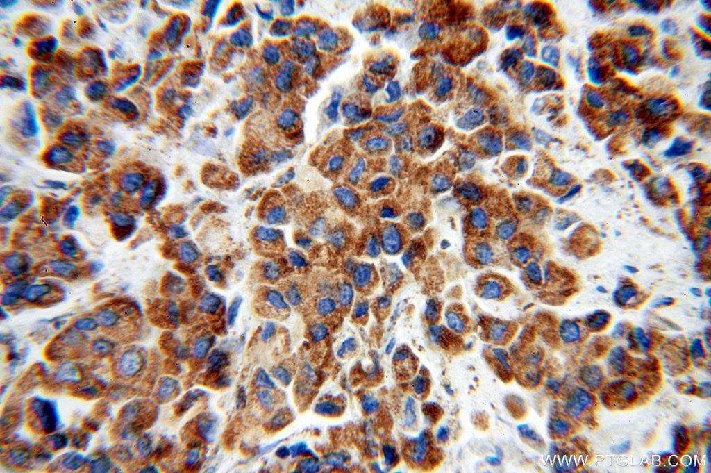 Immunohistochemistry (IHC) staining of human breast cancer tissue using IRS1 Polyclonal antibody (17509-1-AP)