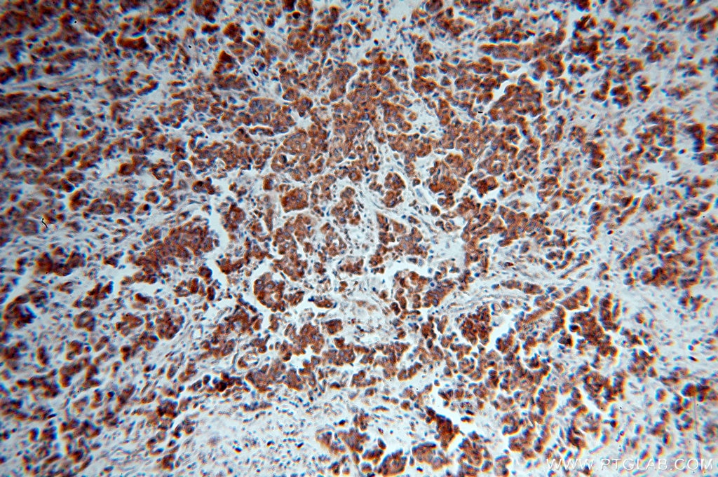 Immunohistochemistry (IHC) staining of human breast cancer tissue using IRS1 Polyclonal antibody (17509-1-AP)