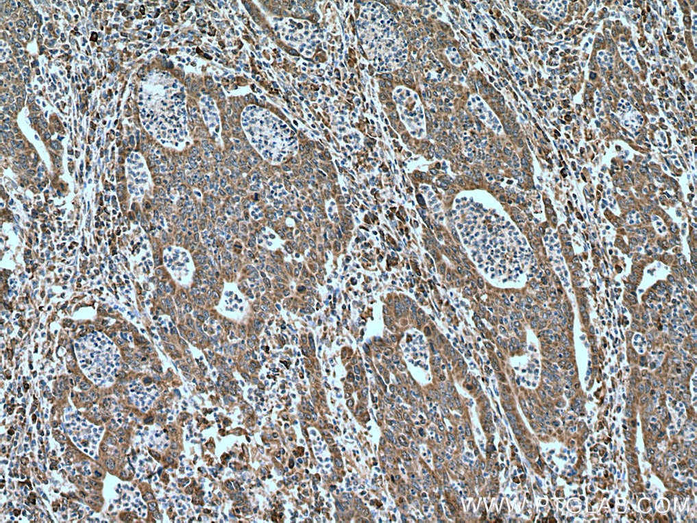 Immunohistochemistry (IHC) staining of human colon cancer tissue using IRX6 Polyclonal antibody (24440-1-AP)