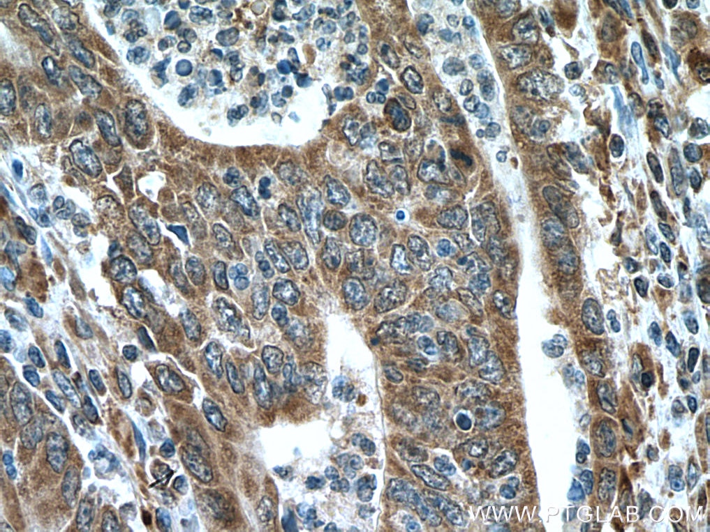 Immunohistochemistry (IHC) staining of human colon cancer tissue using IRX6 Polyclonal antibody (24440-1-AP)