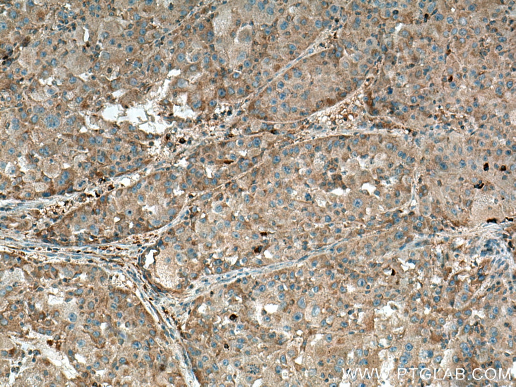 IHC staining of human liver cancer using 13200-1-AP