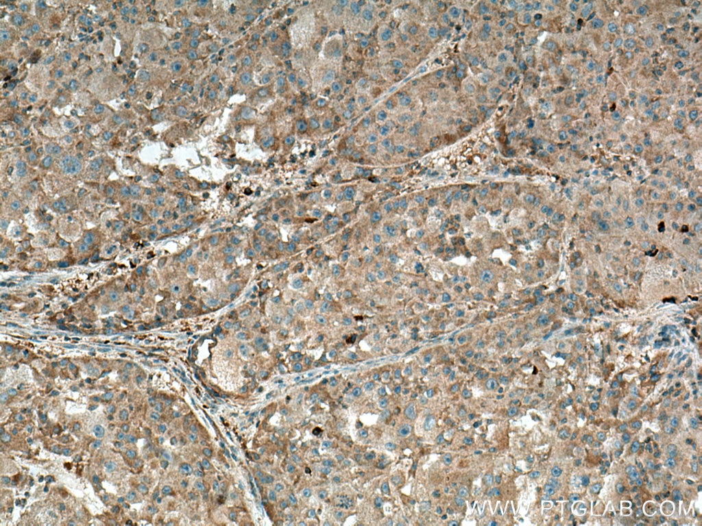 Immunohistochemistry (IHC) staining of human liver cancer tissue using ISCA2 Polyclonal antibody (13200-1-AP)