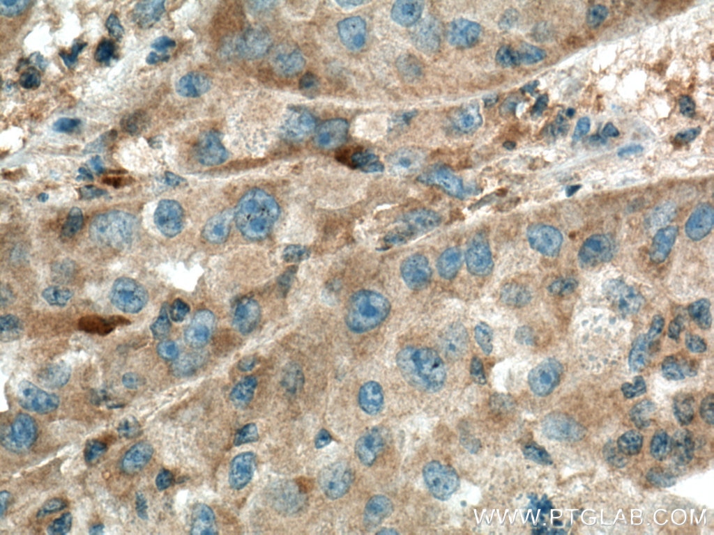 IHC staining of human liver cancer using 13200-1-AP