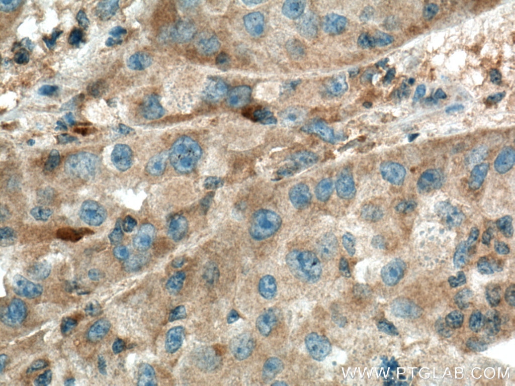 Immunohistochemistry (IHC) staining of human liver cancer tissue using ISCA2 Polyclonal antibody (13200-1-AP)