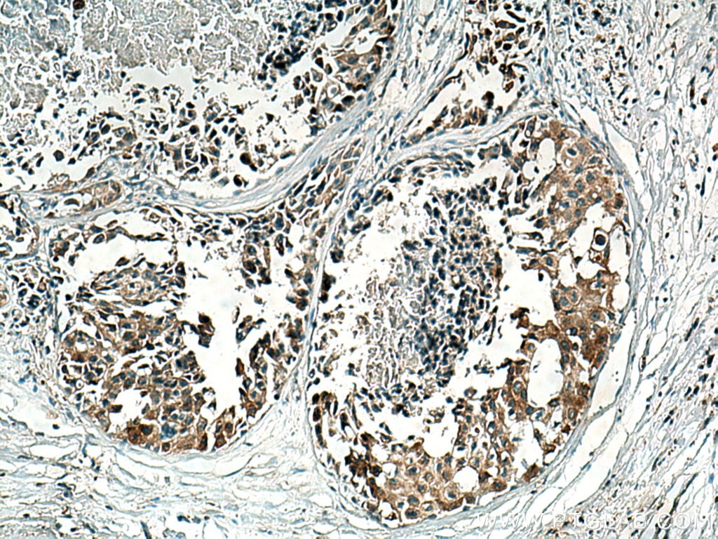 IHC staining of human breast cancer using 13200-1-AP