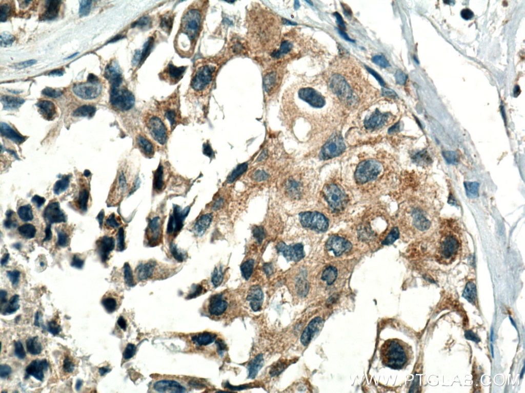 Immunohistochemistry (IHC) staining of human breast cancer tissue using ISCA2 Polyclonal antibody (13200-1-AP)