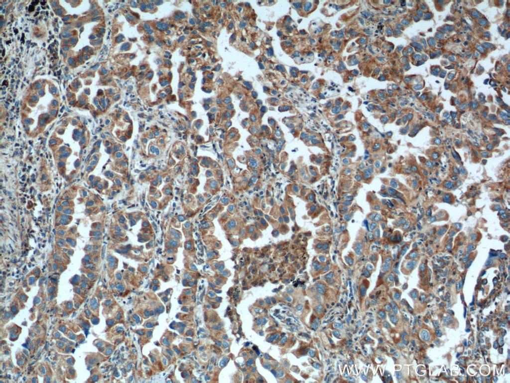 Immunohistochemistry (IHC) staining of human lung cancer tissue using ISCU Polyclonal antibody (14812-1-AP)
