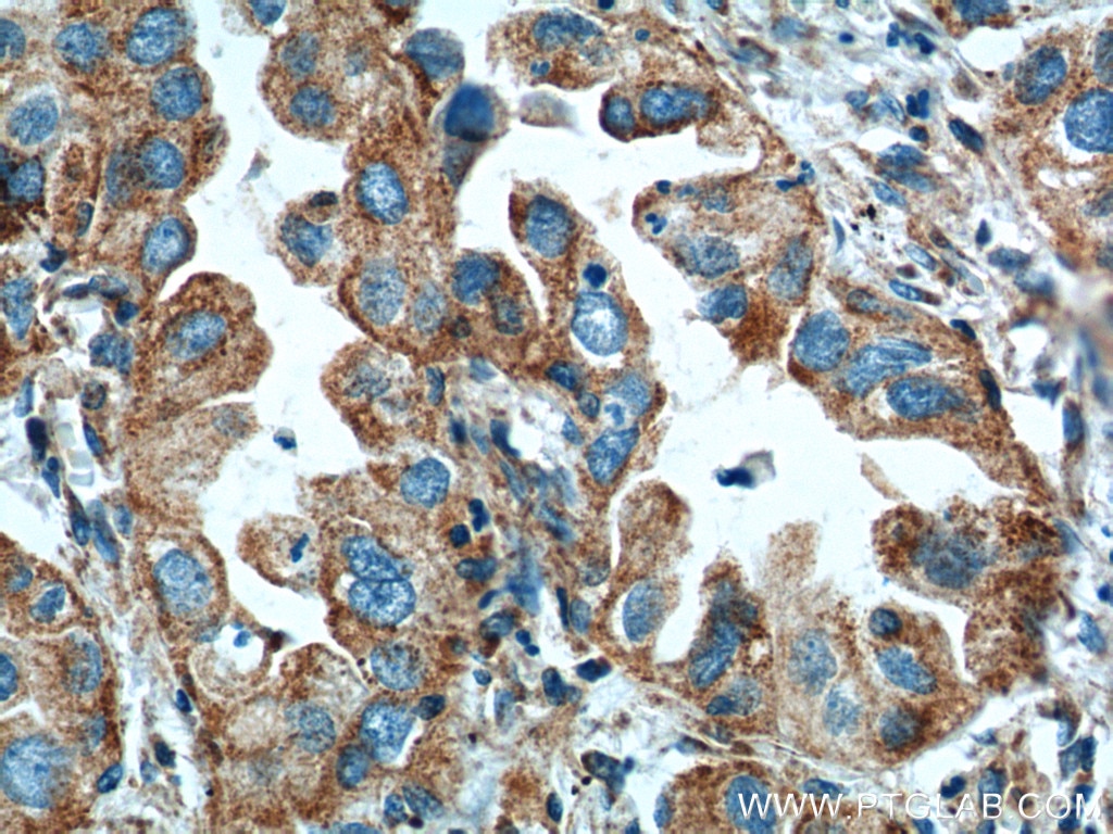 Immunohistochemistry (IHC) staining of human lung cancer tissue using ISCU Polyclonal antibody (14812-1-AP)