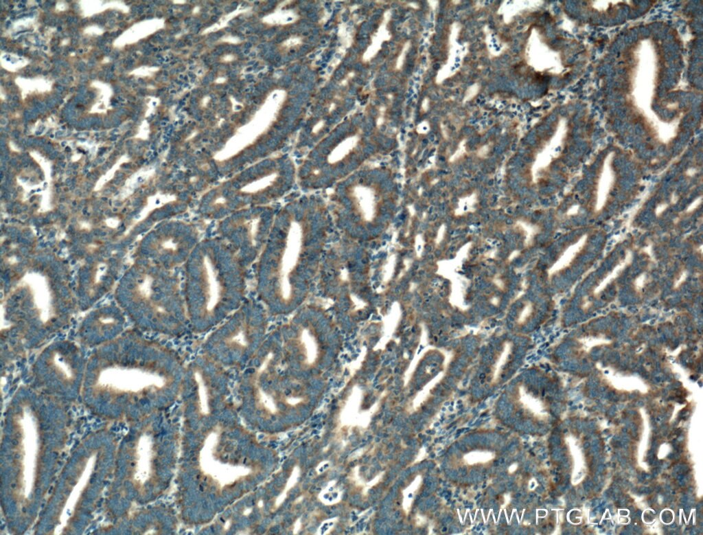 Immunohistochemistry (IHC) staining of human endometrial cancer tissue using ISCU Polyclonal antibody (14812-1-AP)