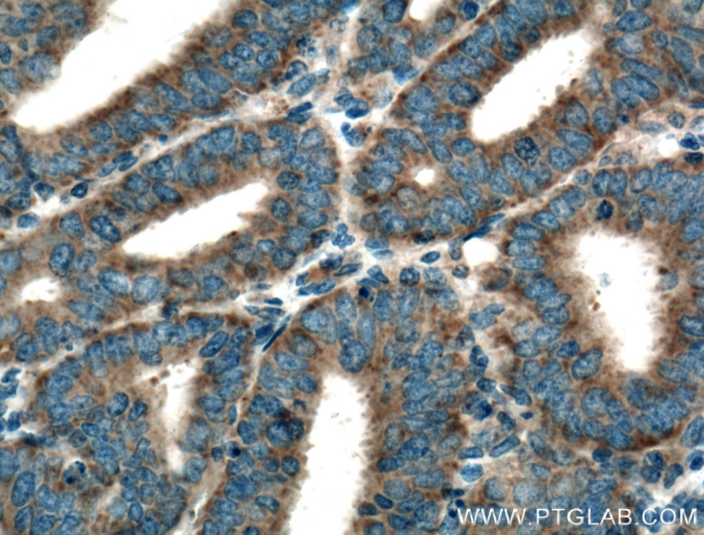 Immunohistochemistry (IHC) staining of human endometrial cancer tissue using ISCU Polyclonal antibody (14812-1-AP)