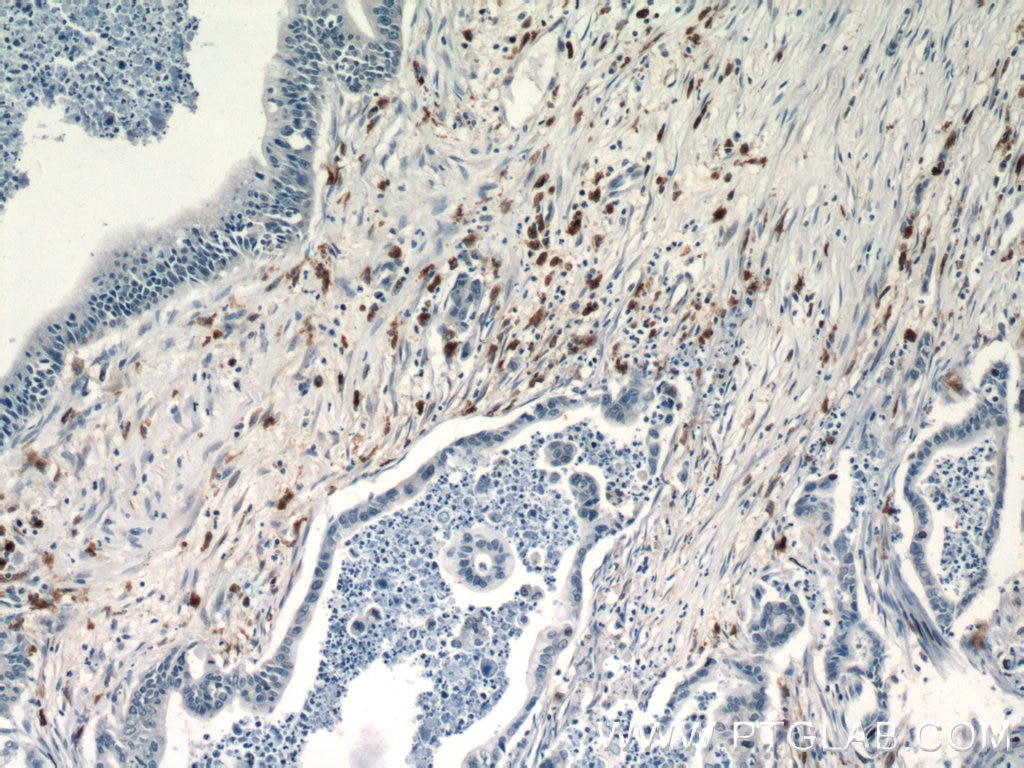 IHC staining of human pancreas cancer using 15981-1-AP
