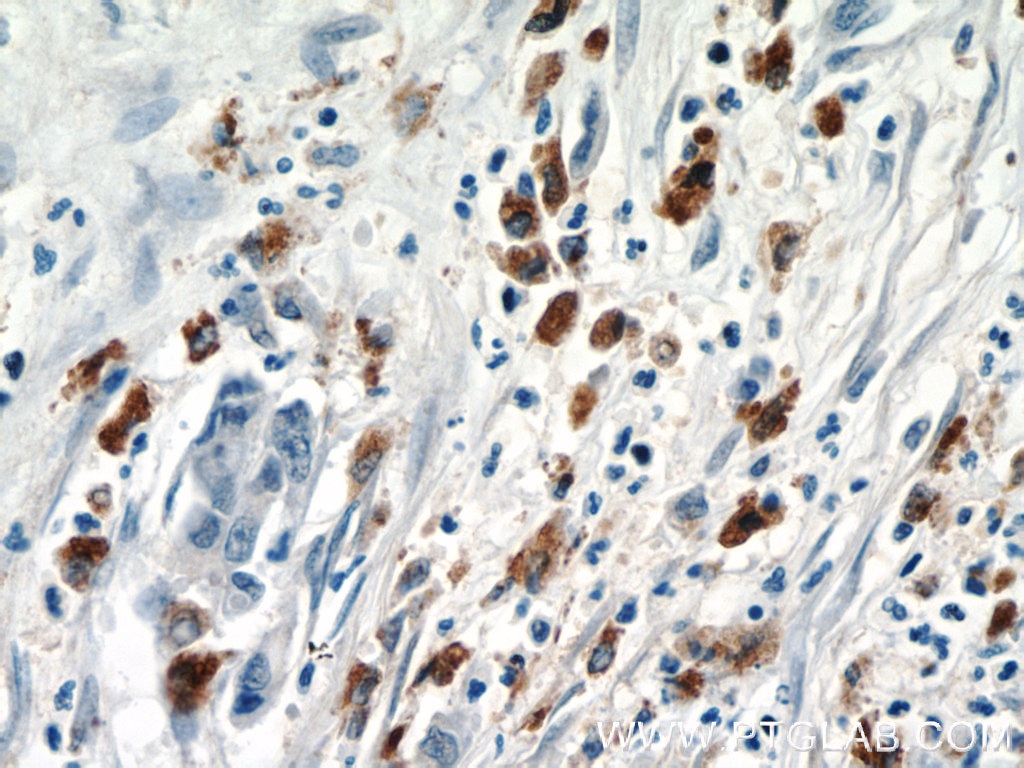 Immunohistochemistry (IHC) staining of human pancreas cancer tissue using ISG15 Polyclonal antibody (15981-1-AP)
