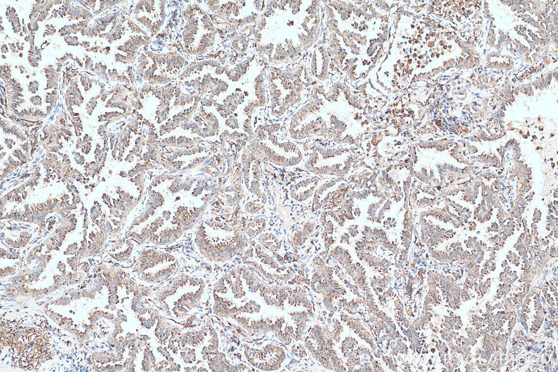 Immunohistochemistry (IHC) staining of human lung cancer tissue using ISG15 Polyclonal antibody (15981-1-AP)