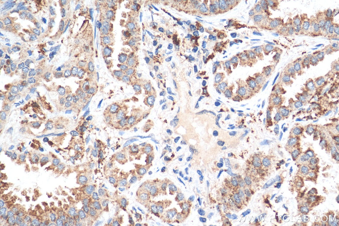 Immunohistochemistry (IHC) staining of human lung cancer tissue using ISG15 Polyclonal antibody (15981-1-AP)