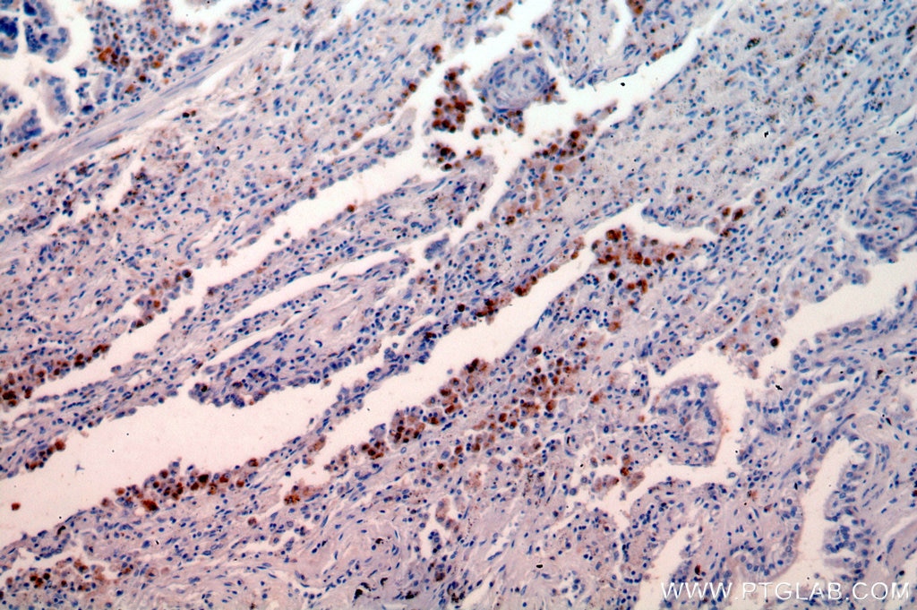 Immunohistochemistry (IHC) staining of human lung cancer tissue using ISG15 Polyclonal antibody (15981-1-AP)