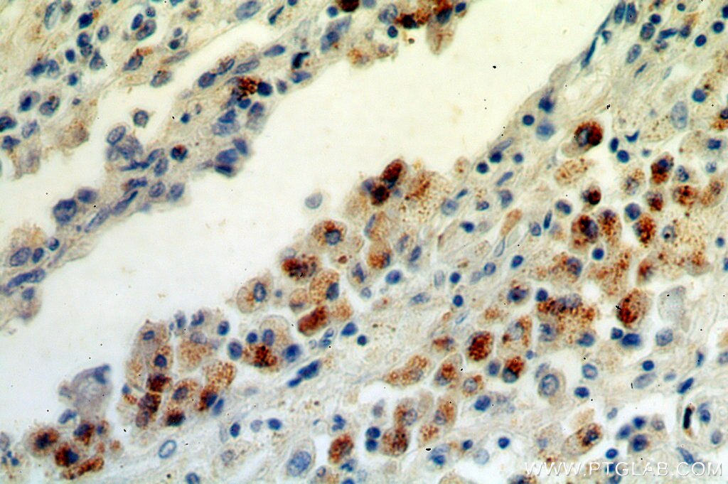 Immunohistochemistry (IHC) staining of human lung cancer tissue using ISG15 Polyclonal antibody (15981-1-AP)