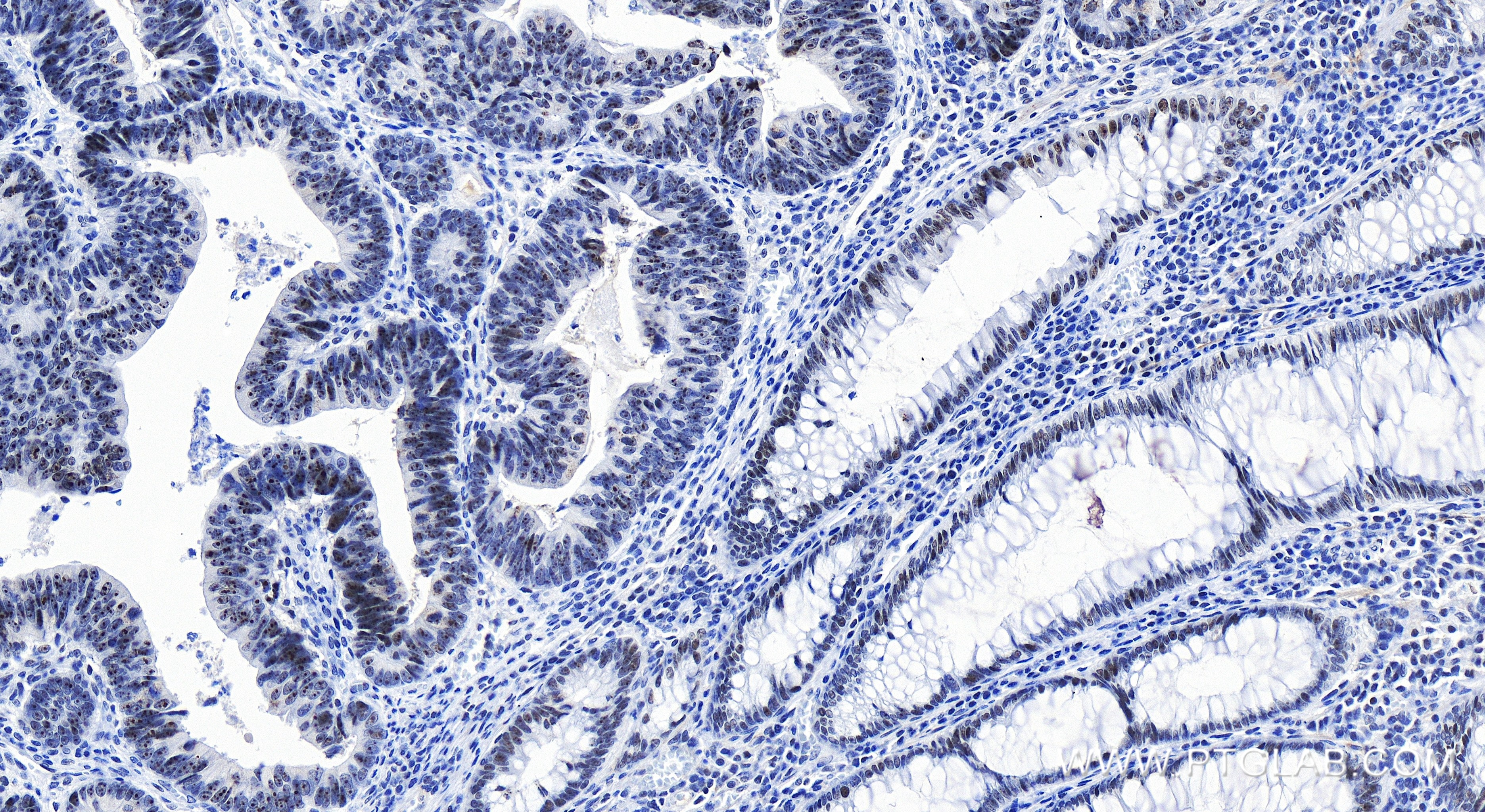 Immunohistochemistry (IHC) staining of human colon cancer tissue using ISG20L2 Recombinant antibody (85992-2-RR)