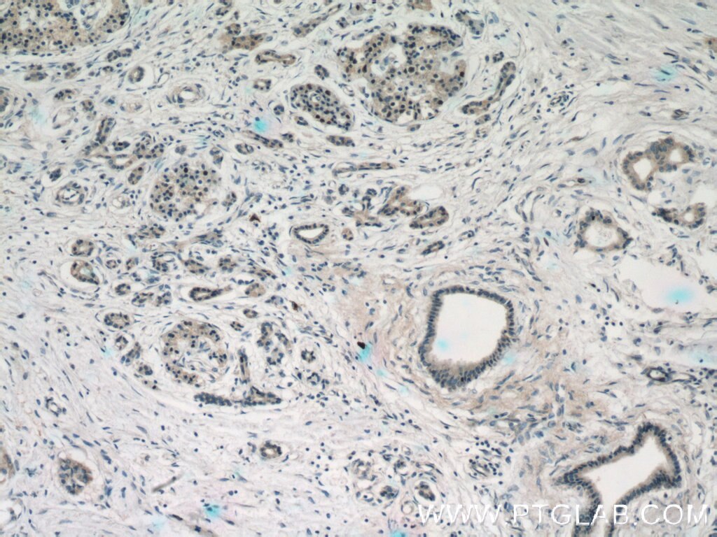 Immunohistochemistry (IHC) staining of human pancreas cancer tissue using Islet 1 Polyclonal antibody (15661-1-AP)