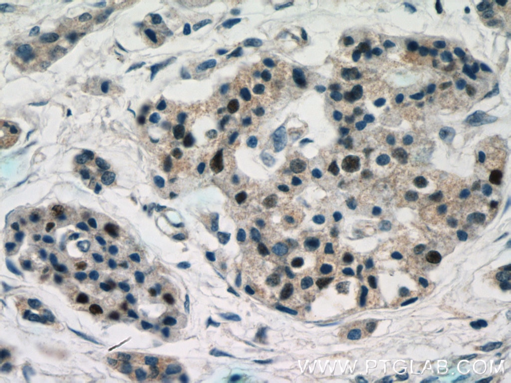 IHC staining of human pancreas cancer using 15661-1-AP