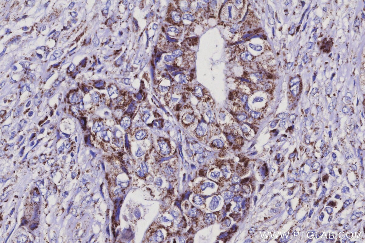 IHC staining of human pancreas cancer using 27082-1-AP Immunohistochemistry (IHC) staining of human pancreas cancer tissue using ISOC2 Polyclonal antibody (27082-1-AP)